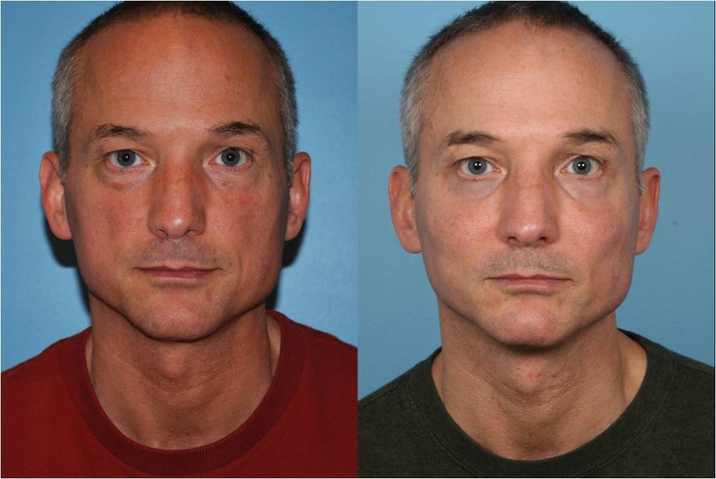 cheekbone implants men before and after