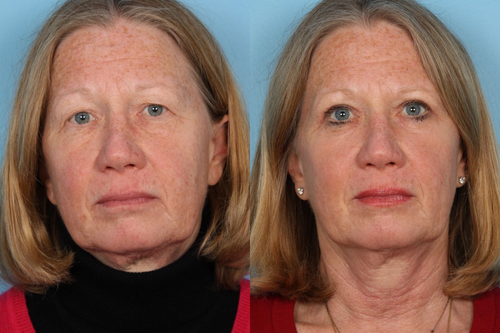 Blepharoplasty (Eyelid Surgery)