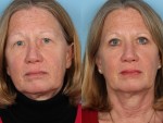 Blepharoplasty (Eyelid Surgery)