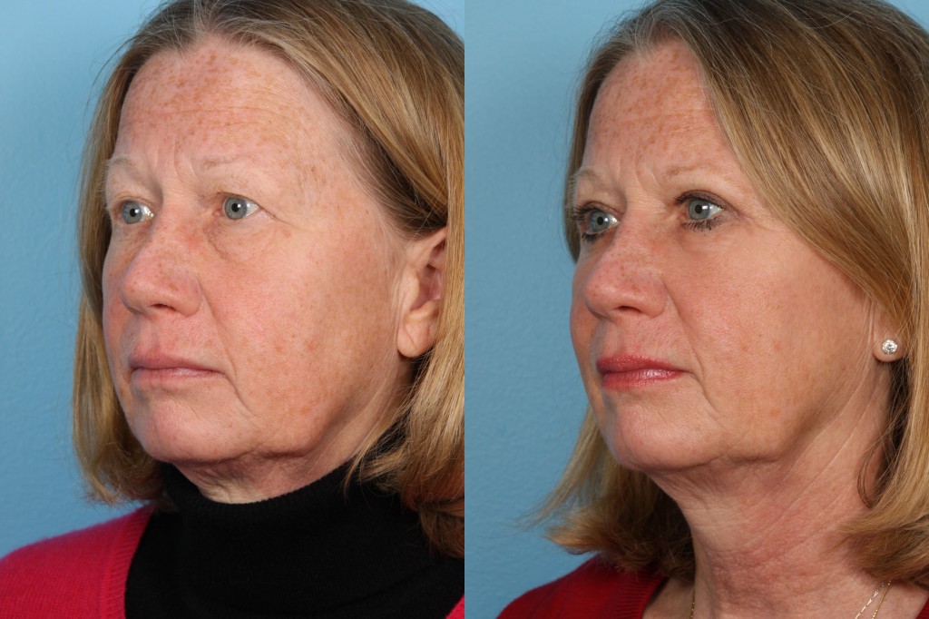 Blepharoplasty (Eyelid Surgery)