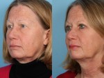 Blepharoplasty (Eyelid Surgery)