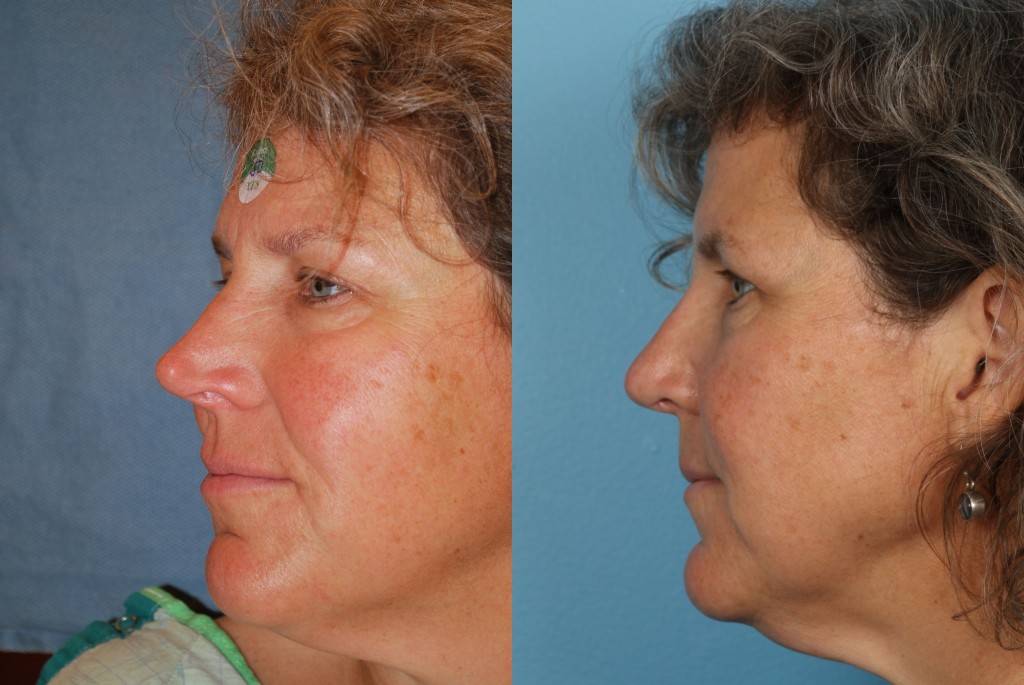 Revisions Rhinoplasty