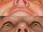 Revision Rhinoplasty