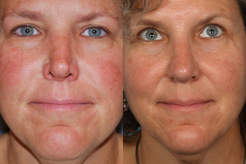 Revisions Rhinoplasty