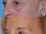 Blepharoplasty (Eyelid Surgery)