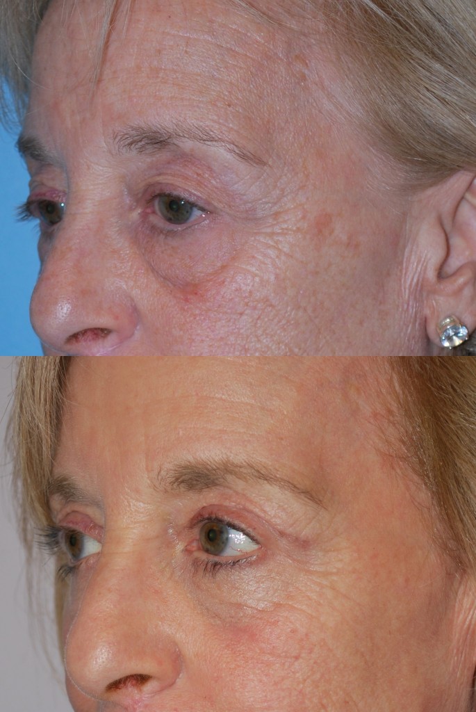 Blepharoplasty (Eyelid Surgery)