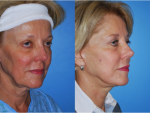 Facelift and Necklift