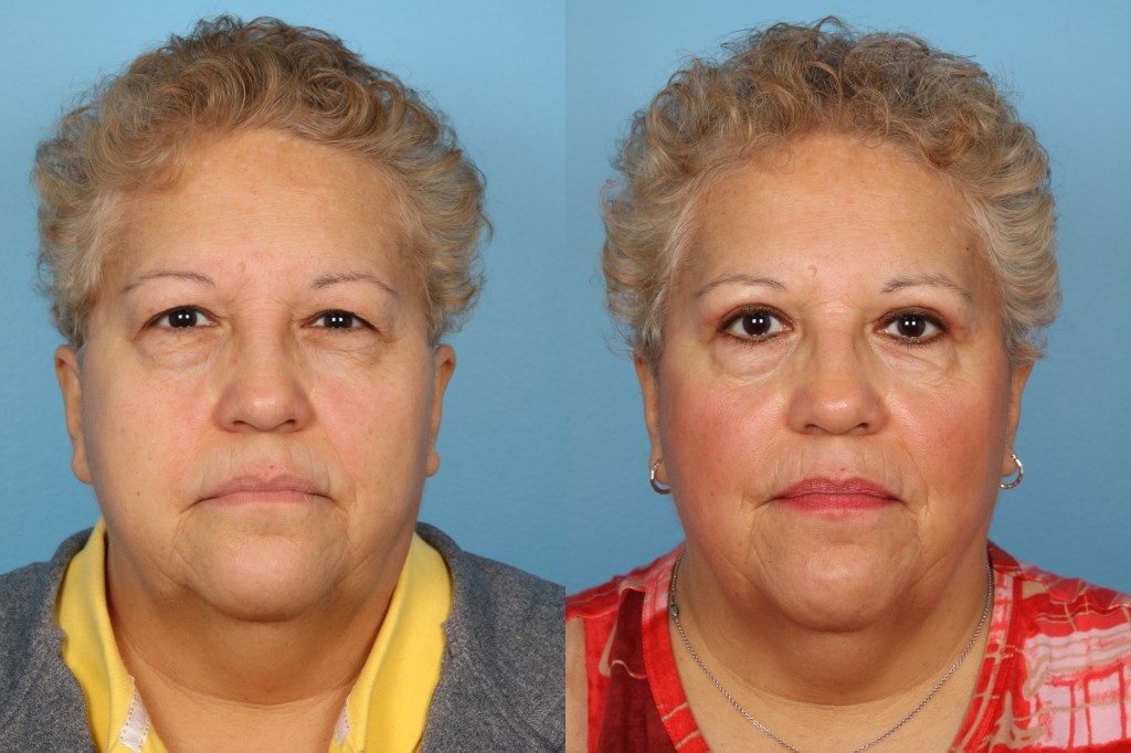 Blepharoplasty (Eyelid Surgery)