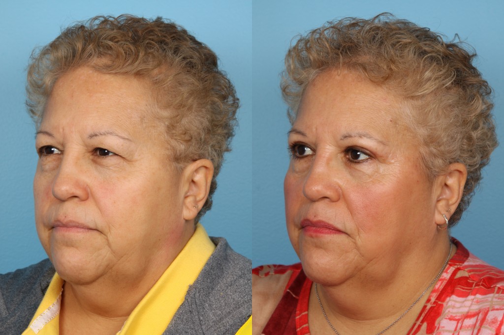 Blepharoplasty (Eyelid Surgery)