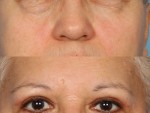 Blepharoplasty (Eyelid Surgery)