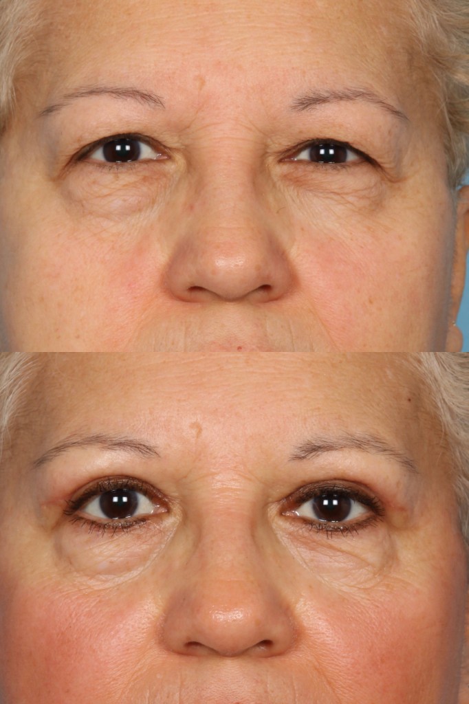 Blepharoplasty (Eyelid Surgery)