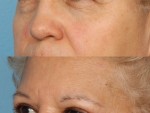 Blepharoplasty (Eyelid Surgery)