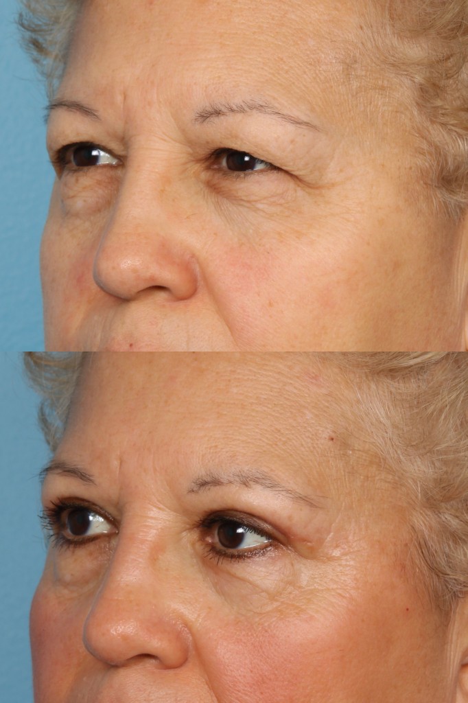 Blepharoplasty (Eyelid Surgery)