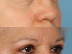 Blepharoplasty (Eyelid Surgery)