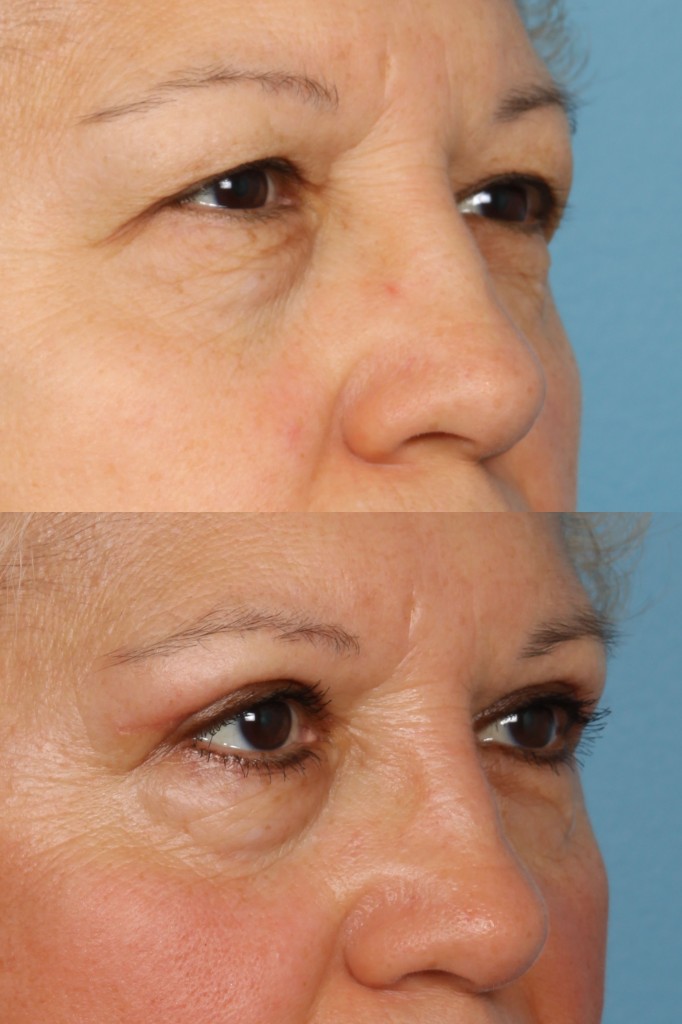 Blepharoplasty (Eyelid Surgery)