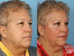 Blepharoplasty (Eyelid Surgery)