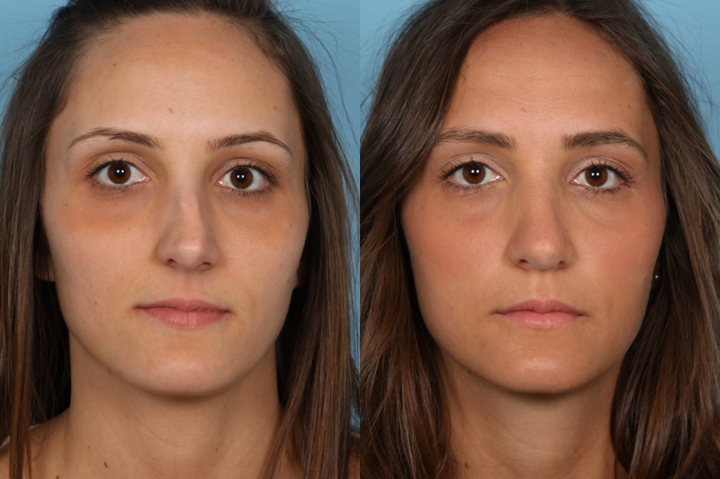 Rhinoplasty (Nose Job)