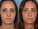 Rhinoplasty (Nose Job)