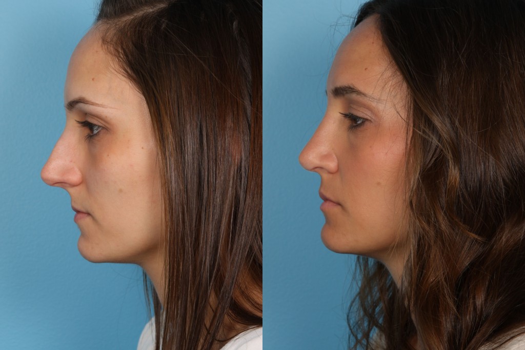 Rhinoplasty (Nose Job)