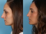 Rhinoplasty (Nose Job)