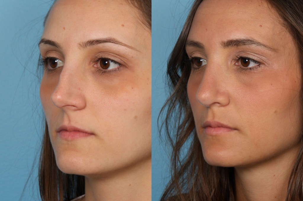 Rhinoplasty (Nose Job)