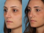 Rhinoplasty (Nose Job)