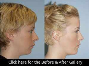 Chicago Chin & Cheek Implant Surgery