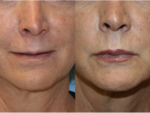 Botox and Injectables