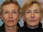 Botox and Injectables