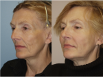 Botox and Injectables