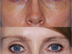 Botox and Injectables