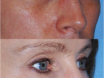 Botox and Injectables