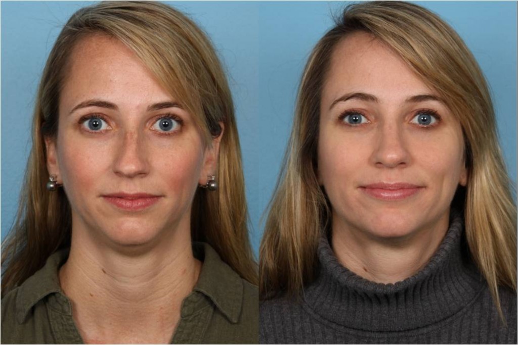 Rhinoplasty (Nose Job)