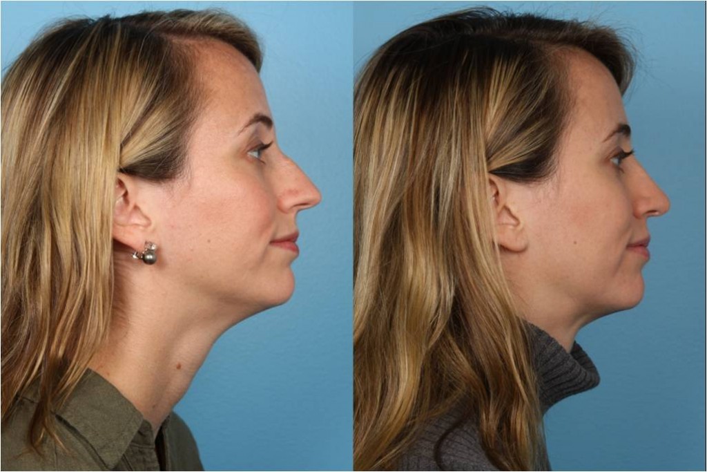 Rhinoplasty (Nose Job)