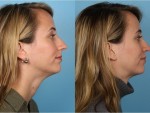 Rhinoplasty (Nose Job)