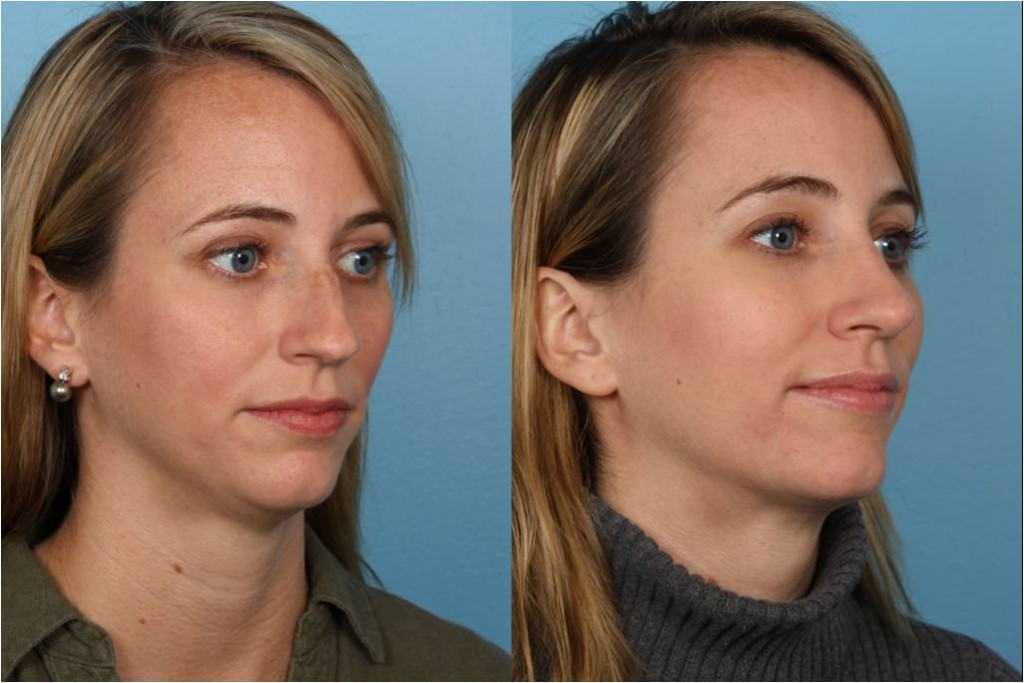 Rhinoplasty (Nose Job)