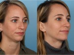 Rhinoplasty (Nose Job)