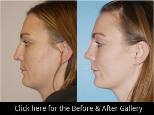 Revisions Rhinoplasty Surgery Chicago, IL