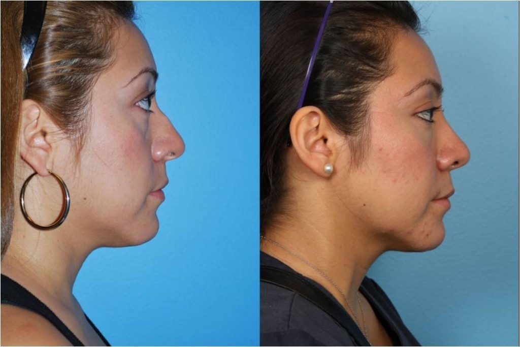 Rhinoplasty (Nose Job)