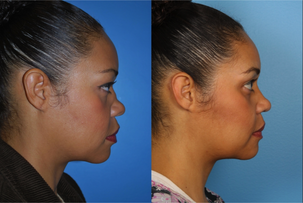 Rhinoplasty (Nose Job)