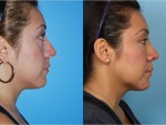 Rhinoplasty (Nose Job)