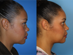 Rhinoplasty (Nose Job)