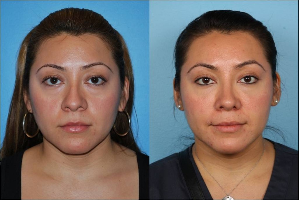 Rhinoplasty (Nose Job)