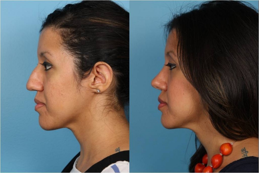Rhinoplasty (Nose Job)