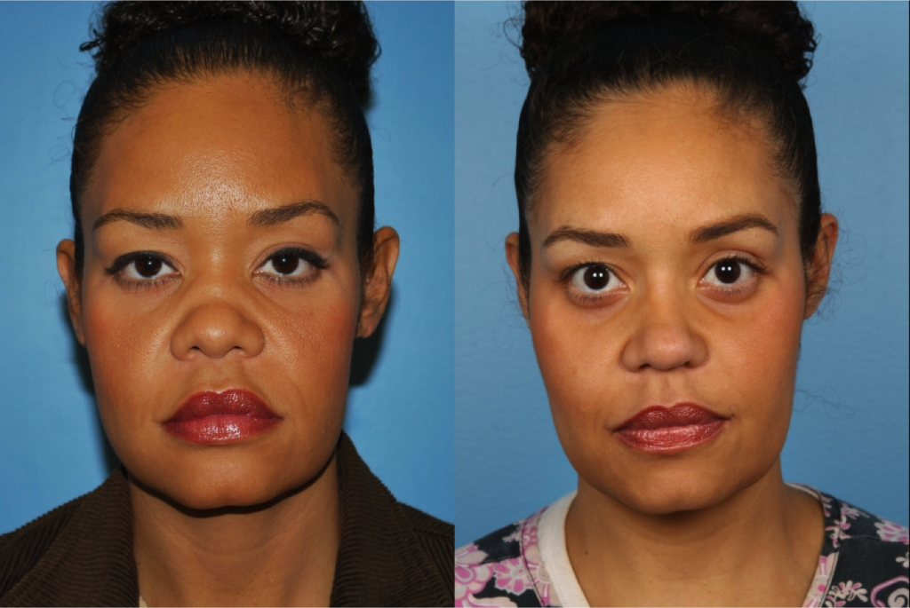 Rhinoplasty (Nose Job)