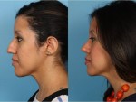 Rhinoplasty (Nose Job)