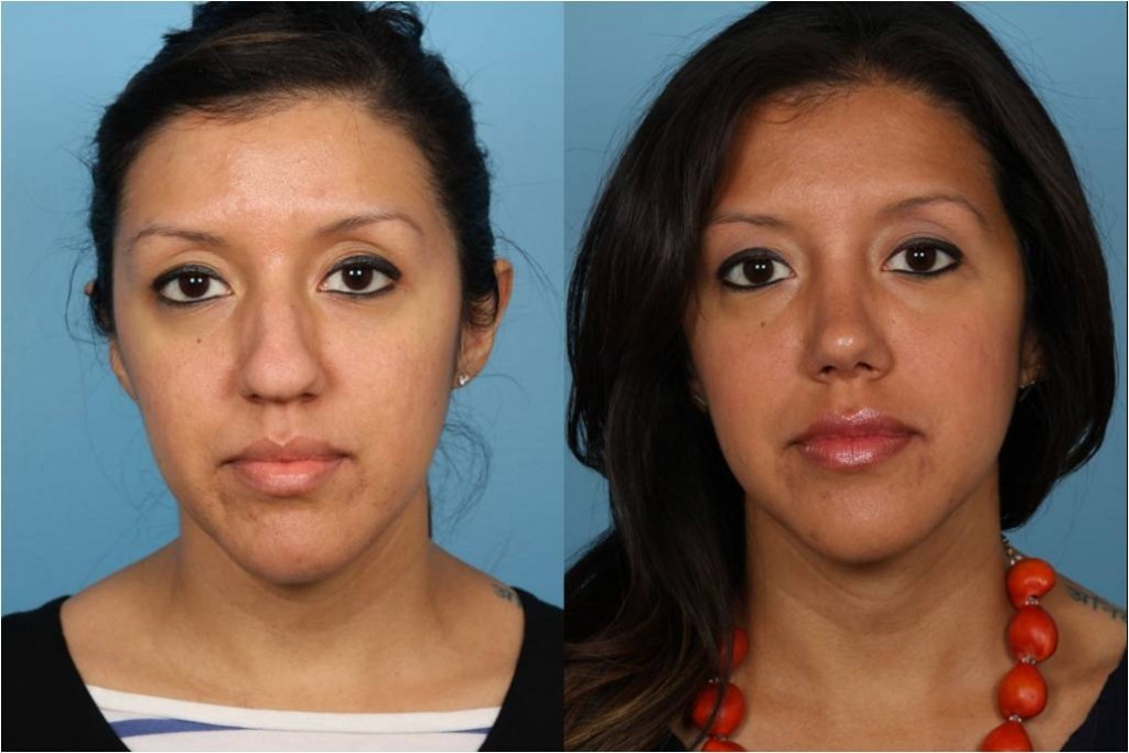 Rhinoplasty (Nose Job)