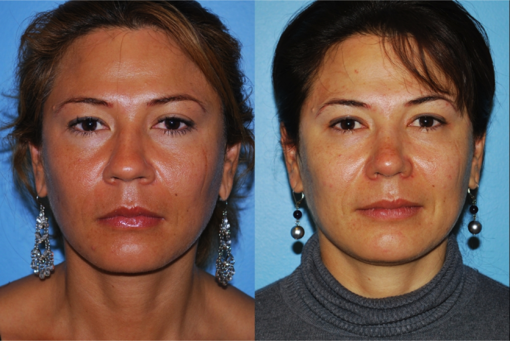 Rhinoplasty (Nose Job)