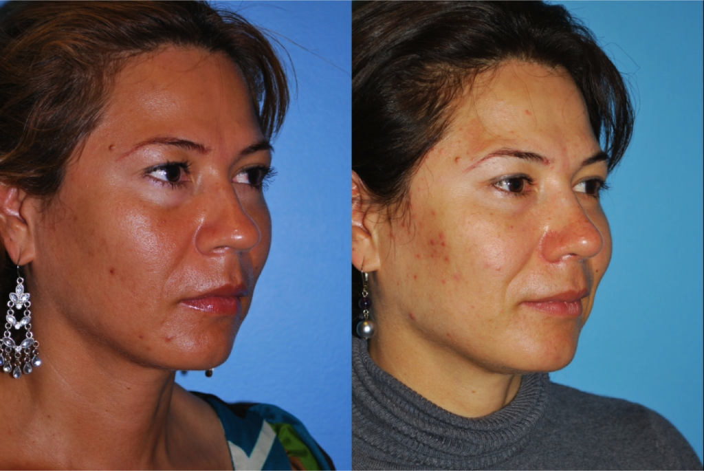 Rhinoplasty (Nose Job)