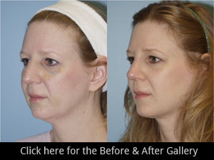 Rhinoplasty Chicago, IL | Nose Job Surgery